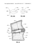 SPINAL IMPLANTS AND METHODS diagram and image