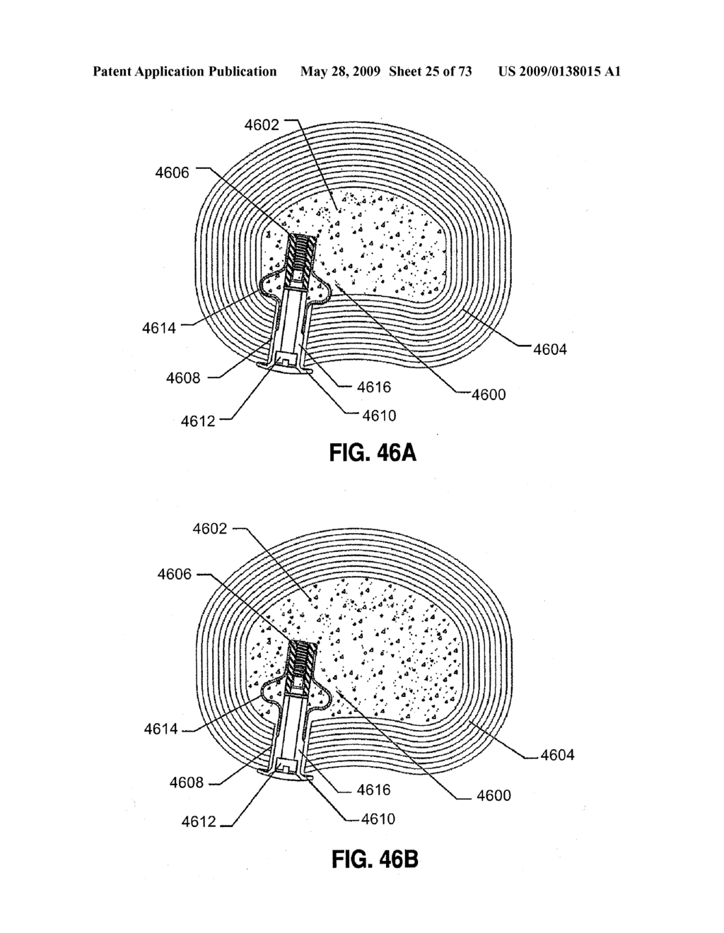 SPINAL IMPLANTS AND METHODS - diagram, schematic, and image 26