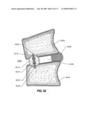 SPINAL IMPLANTS AND METHODS diagram and image