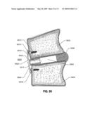 SPINAL IMPLANTS AND METHODS diagram and image