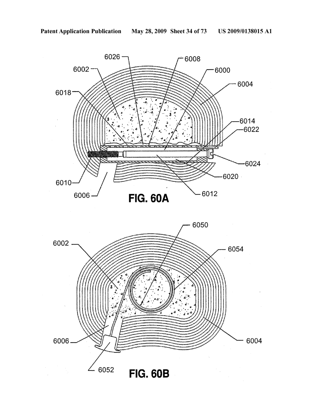 SPINAL IMPLANTS AND METHODS - diagram, schematic, and image 35