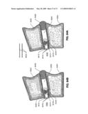 SPINAL IMPLANTS AND METHODS diagram and image