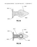 SPINAL IMPLANTS AND METHODS diagram and image