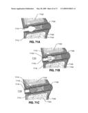 SPINAL IMPLANTS AND METHODS diagram and image