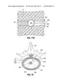 SPINAL IMPLANTS AND METHODS diagram and image