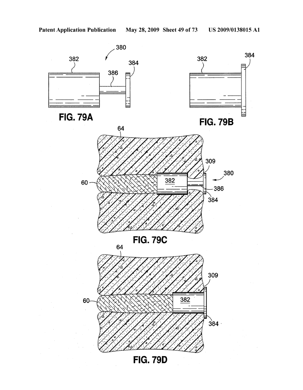 SPINAL IMPLANTS AND METHODS - diagram, schematic, and image 50