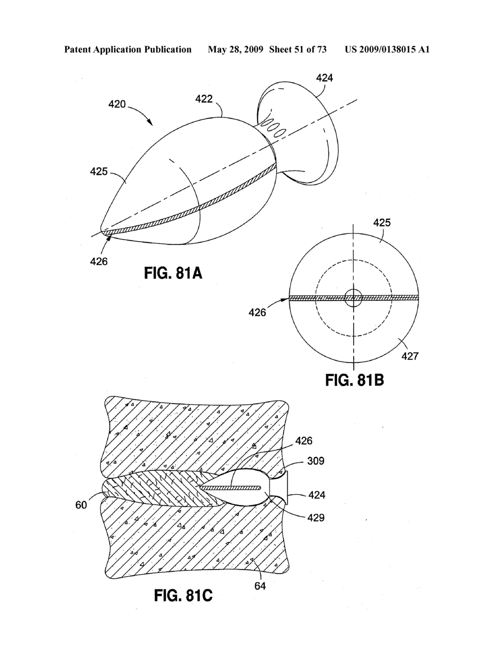 SPINAL IMPLANTS AND METHODS - diagram, schematic, and image 52