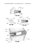 SPINAL IMPLANTS AND METHODS diagram and image