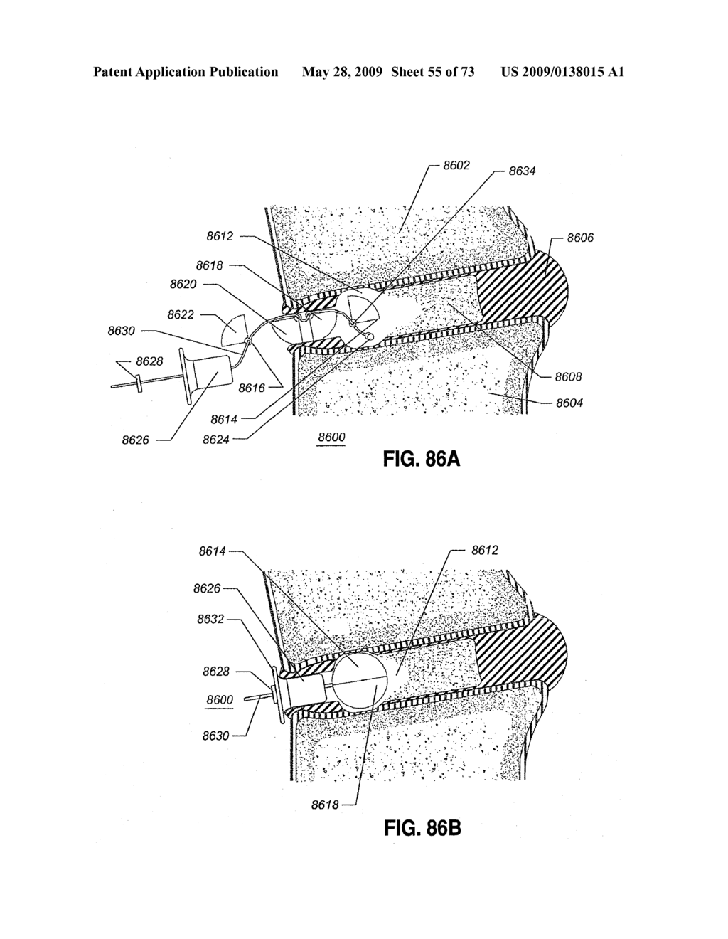 SPINAL IMPLANTS AND METHODS - diagram, schematic, and image 56