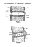 SPINAL IMPLANTS AND METHODS diagram and image