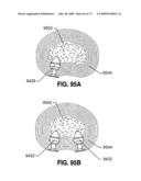 SPINAL IMPLANTS AND METHODS diagram and image