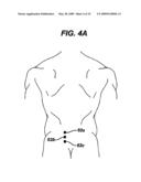 METHODS AND DEVICES FOR MINIMALLY INVASIVE SPINAL FIXATION ELEMENT PLACEMENT diagram and image