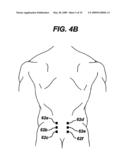 METHODS AND DEVICES FOR MINIMALLY INVASIVE SPINAL FIXATION ELEMENT PLACEMENT diagram and image