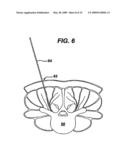 METHODS AND DEVICES FOR MINIMALLY INVASIVE SPINAL FIXATION ELEMENT PLACEMENT diagram and image