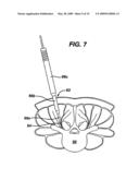 METHODS AND DEVICES FOR MINIMALLY INVASIVE SPINAL FIXATION ELEMENT PLACEMENT diagram and image