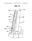 METHODS AND DEVICES FOR MINIMALLY INVASIVE SPINAL FIXATION ELEMENT PLACEMENT diagram and image