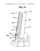 METHODS AND DEVICES FOR MINIMALLY INVASIVE SPINAL FIXATION ELEMENT PLACEMENT diagram and image