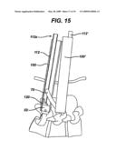 METHODS AND DEVICES FOR MINIMALLY INVASIVE SPINAL FIXATION ELEMENT PLACEMENT diagram and image