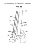 METHODS AND DEVICES FOR MINIMALLY INVASIVE SPINAL FIXATION ELEMENT PLACEMENT diagram and image