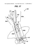 METHODS AND DEVICES FOR MINIMALLY INVASIVE SPINAL FIXATION ELEMENT PLACEMENT diagram and image