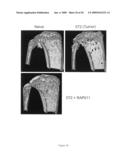 Activin-actriia antagonists and uses for promoting bone growth in cancer patients diagram and image