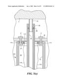 Transluminal endoscopic surgery kit diagram and image