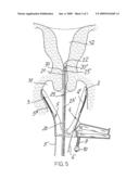 Speculum for the electropharmacological treatment of vaginal diseases diagram and image