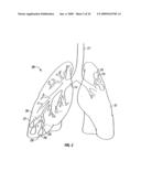 MODIFICATION OF AIRWAYS BY APPLICATION OF ULTRASOUND ENERGY diagram and image