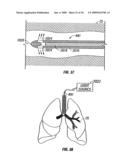 MODIFICATION OF AIRWAYS BY APPLICATION OF ULTRASOUND ENERGY diagram and image