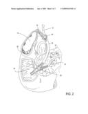 Methods, Devices, Kits and Systems for Defunctionalizing the Gallbladder diagram and image
