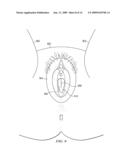 METHOD AND APPARATUS FOR PUBIC SLING INSERTION diagram and image