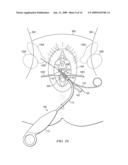 METHOD AND APPARATUS FOR PUBIC SLING INSERTION diagram and image