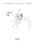 Ophthalmic fluid delivery system diagram and image