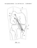 Method And Apparatus For Forming A Bone Tunnel diagram and image