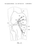 Method And Apparatus For Forming A Bone Tunnel diagram and image