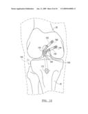 Method And Apparatus For Forming A Bone Tunnel diagram and image