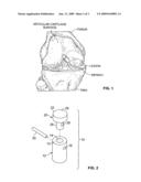 Cancellous Bone Implant for Cartilage Repair diagram and image
