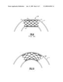 FLEXIBLE STENT diagram and image