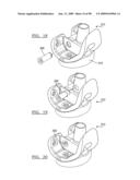 KNEE JOINT PROSTHESIS SYSTEM AND METHOD FOR IMPLANTATION diagram and image