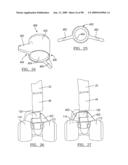 KNEE JOINT PROSTHESIS SYSTEM AND METHOD FOR IMPLANTATION diagram and image