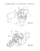 KNEE JOINT PROSTHESIS SYSTEM AND METHOD FOR IMPLANTATION diagram and image