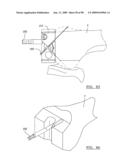 KNEE JOINT PROSTHESIS SYSTEM AND METHOD FOR IMPLANTATION diagram and image