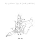 KNEE JOINT PROSTHESIS SYSTEM AND METHOD FOR IMPLANTATION diagram and image