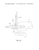 KNEE JOINT PROSTHESIS SYSTEM AND METHOD FOR IMPLANTATION diagram and image