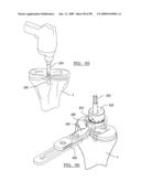 KNEE JOINT PROSTHESIS SYSTEM AND METHOD FOR IMPLANTATION diagram and image