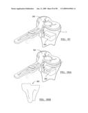 KNEE JOINT PROSTHESIS SYSTEM AND METHOD FOR IMPLANTATION diagram and image