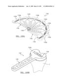 KNEE JOINT PROSTHESIS SYSTEM AND METHOD FOR IMPLANTATION diagram and image