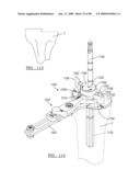 KNEE JOINT PROSTHESIS SYSTEM AND METHOD FOR IMPLANTATION diagram and image