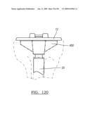 KNEE JOINT PROSTHESIS SYSTEM AND METHOD FOR IMPLANTATION diagram and image