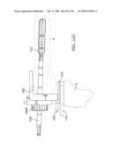 KNEE JOINT PROSTHESIS SYSTEM AND METHOD FOR IMPLANTATION diagram and image